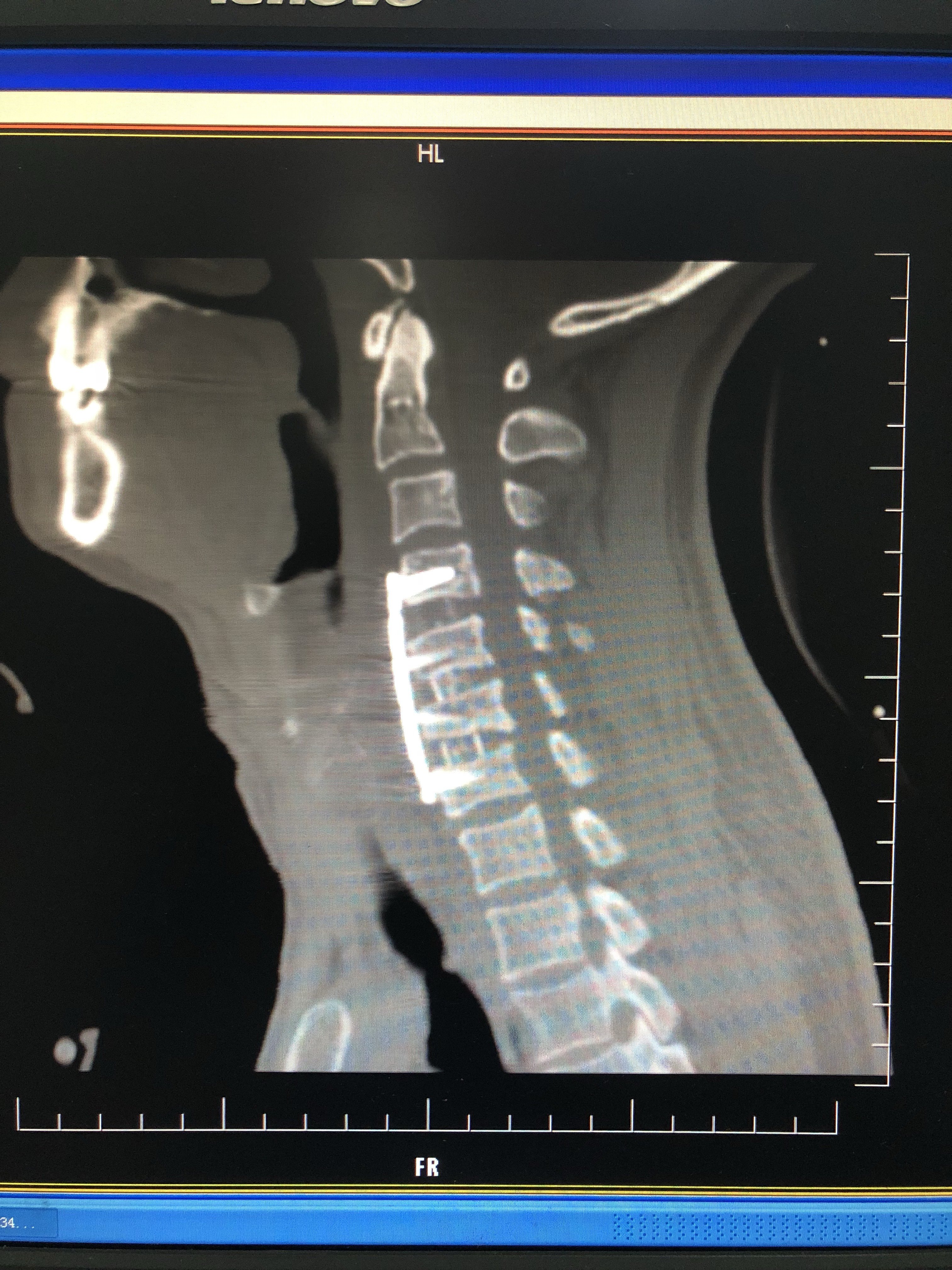 混合型頸椎病的手術治療