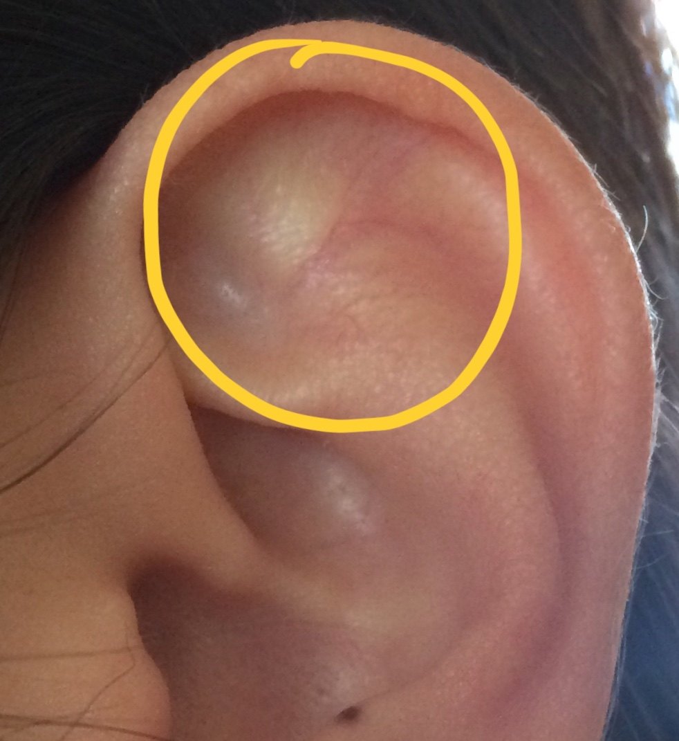 我的左耳对耳轮上脚处本就有一条血络隐现于皮下(研究耳穴后觉得可能