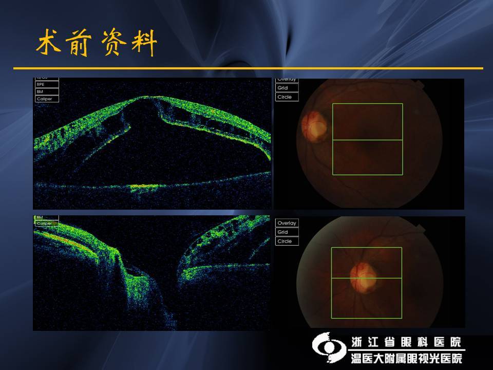 视盘小凹相关黄斑疾病