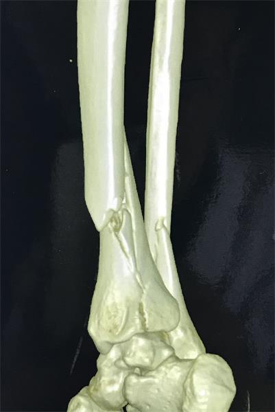 微创治疗胫腓骨粉碎性骨折 好大夫在线 微创治疗胫腓骨粉碎性骨折 好大夫在线