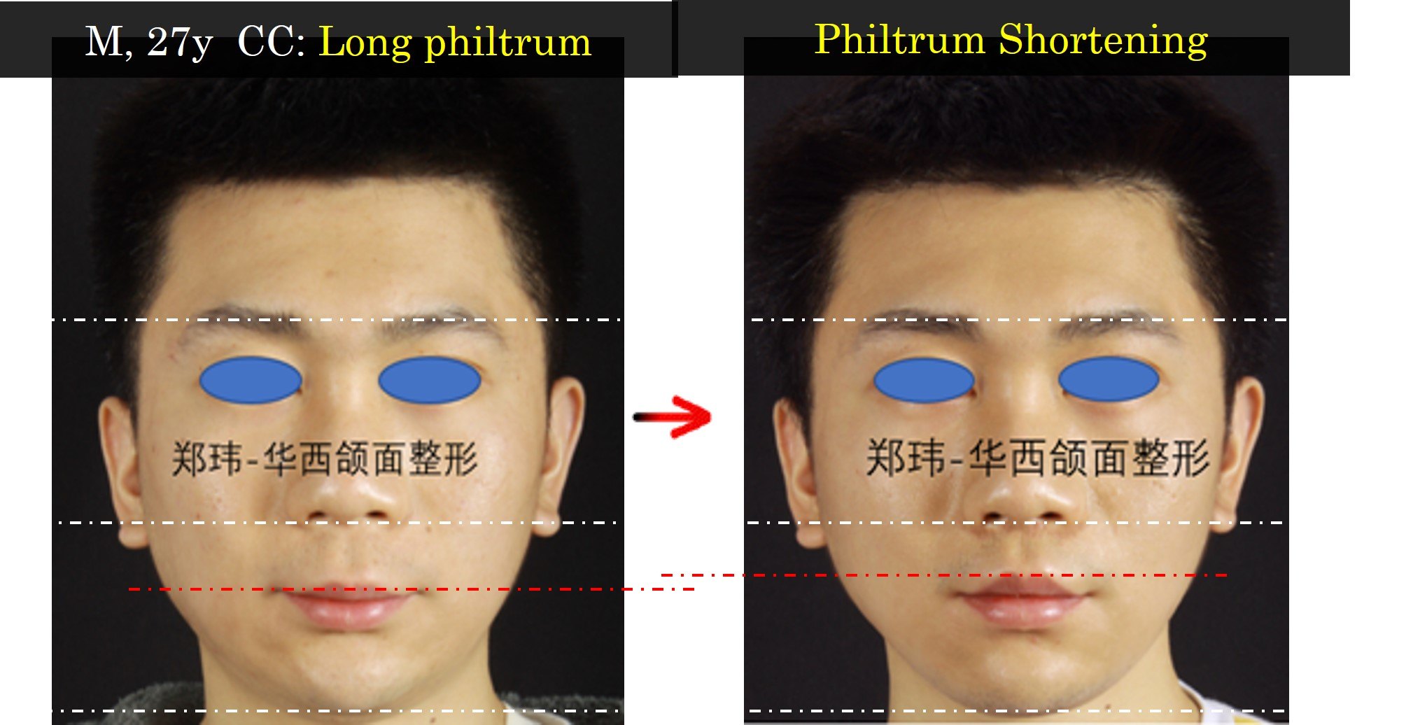 李宇教授華西口腔牙頜面專家團隊唇整形領先技術