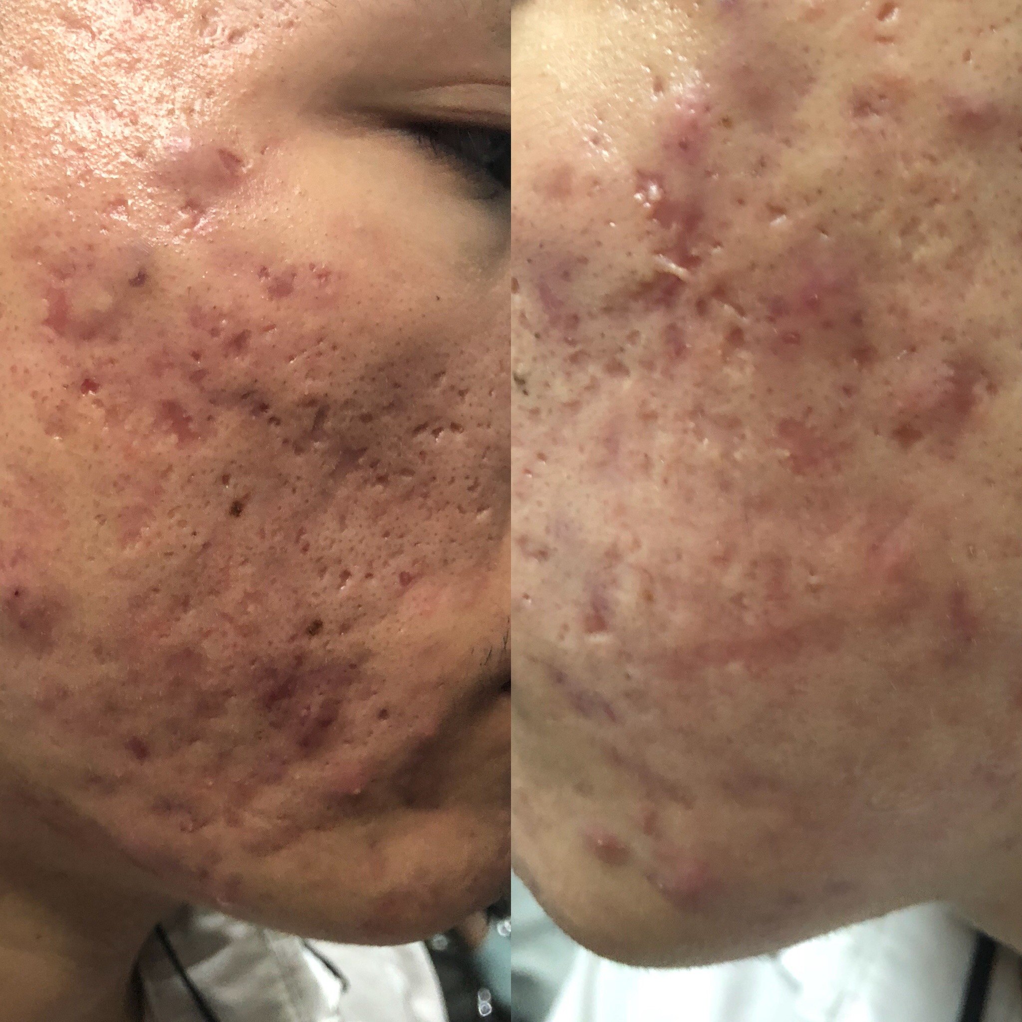 痤疮的分型痤疮专病11