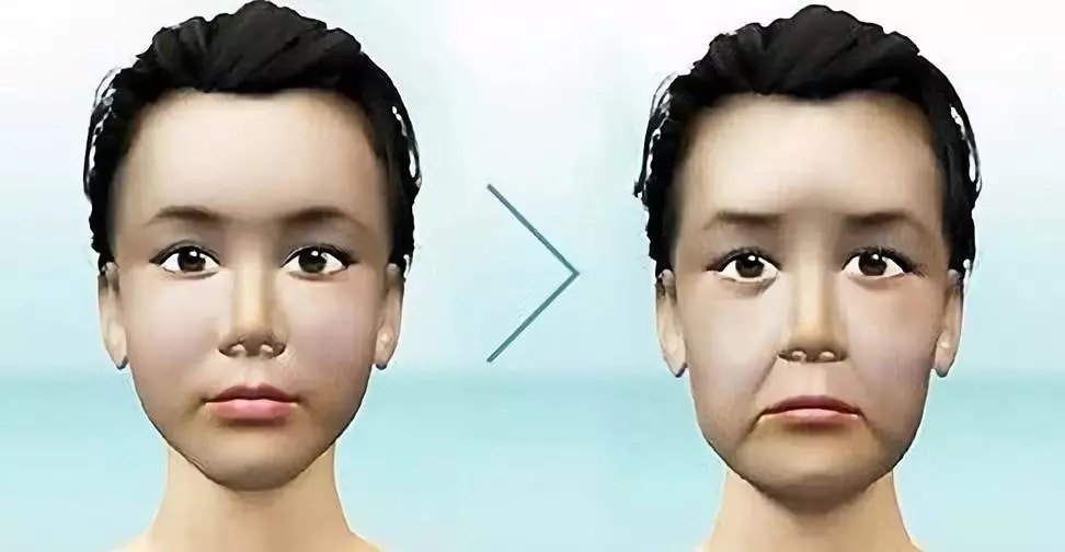 老阿姨,您的颧脂肪垫移位啦! - 好大夫在线