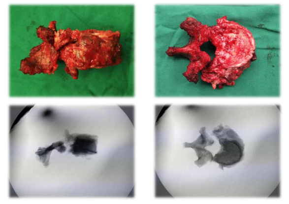 我市首例脊柱腫瘤全脊椎整塊切除3d打印人工椎體植入手術