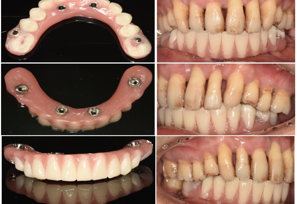 种植牙医王立超博士谈什么是all on 4 - 好大夫在线