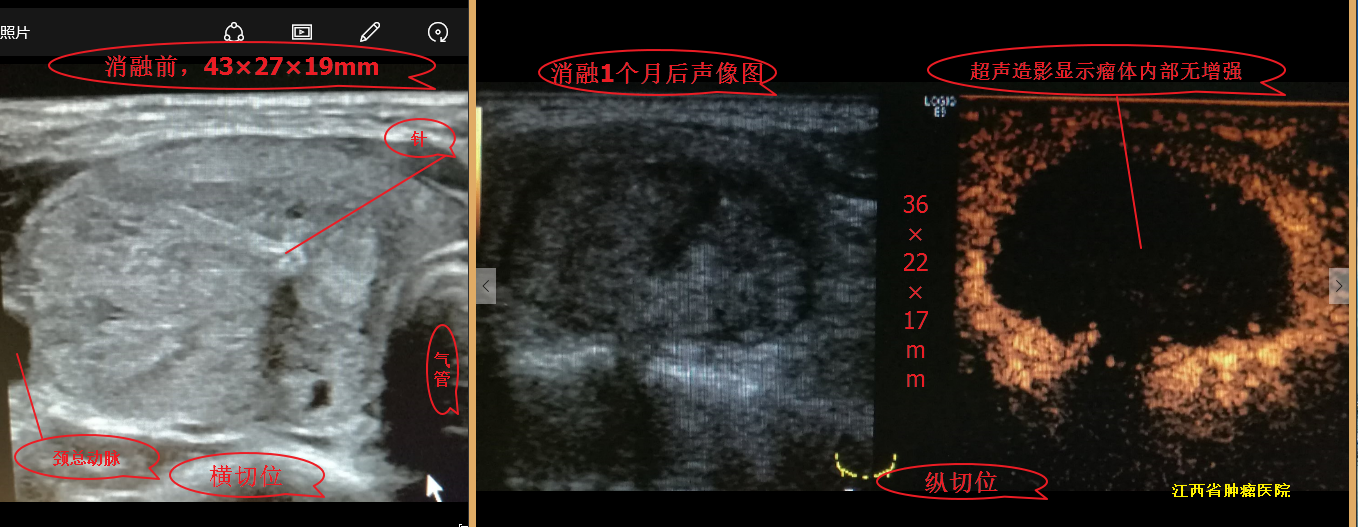 甲状腺结节微波消融术后,随访效果图!