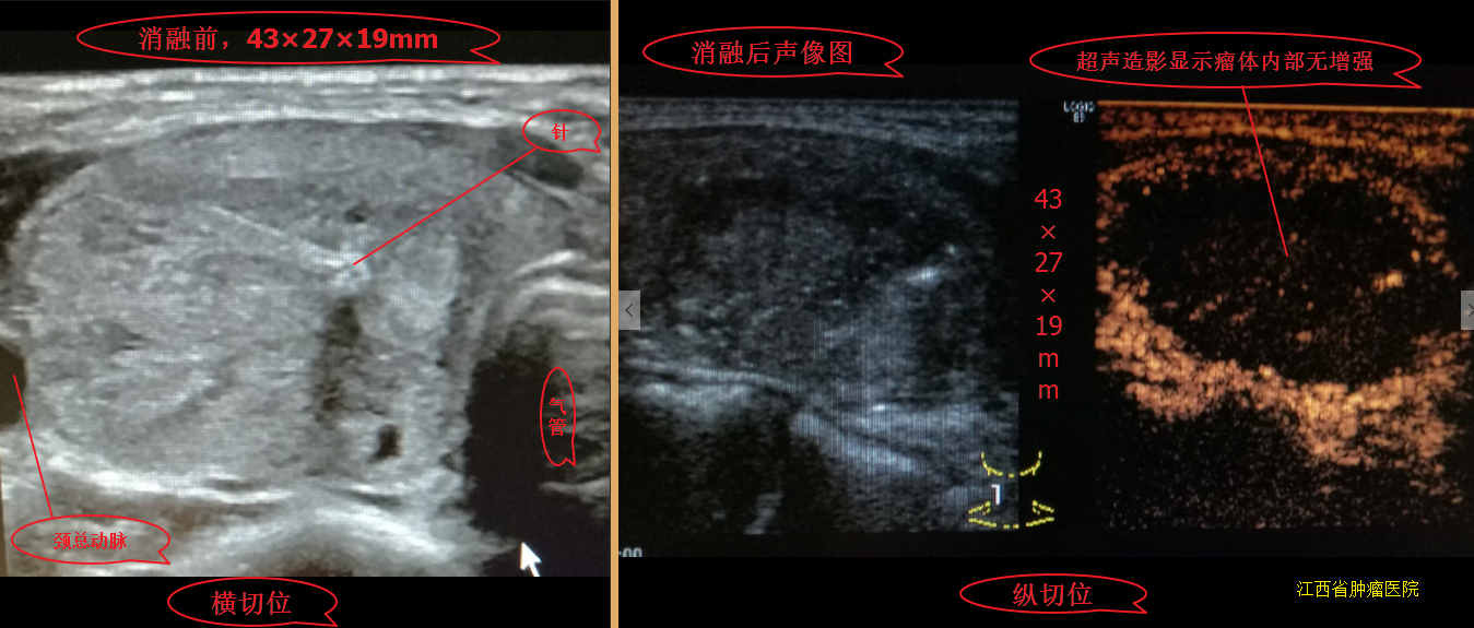 甲状腺结节微波消融术后,随访效果图!