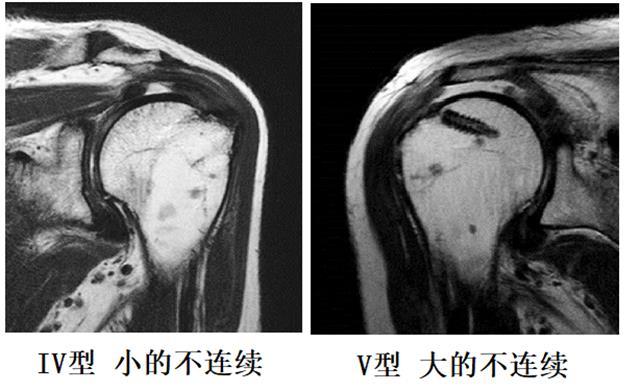 831每日一文巨大肩袖撕裂的修補方法002