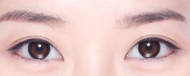 双眼皮割的太窄能修复吗