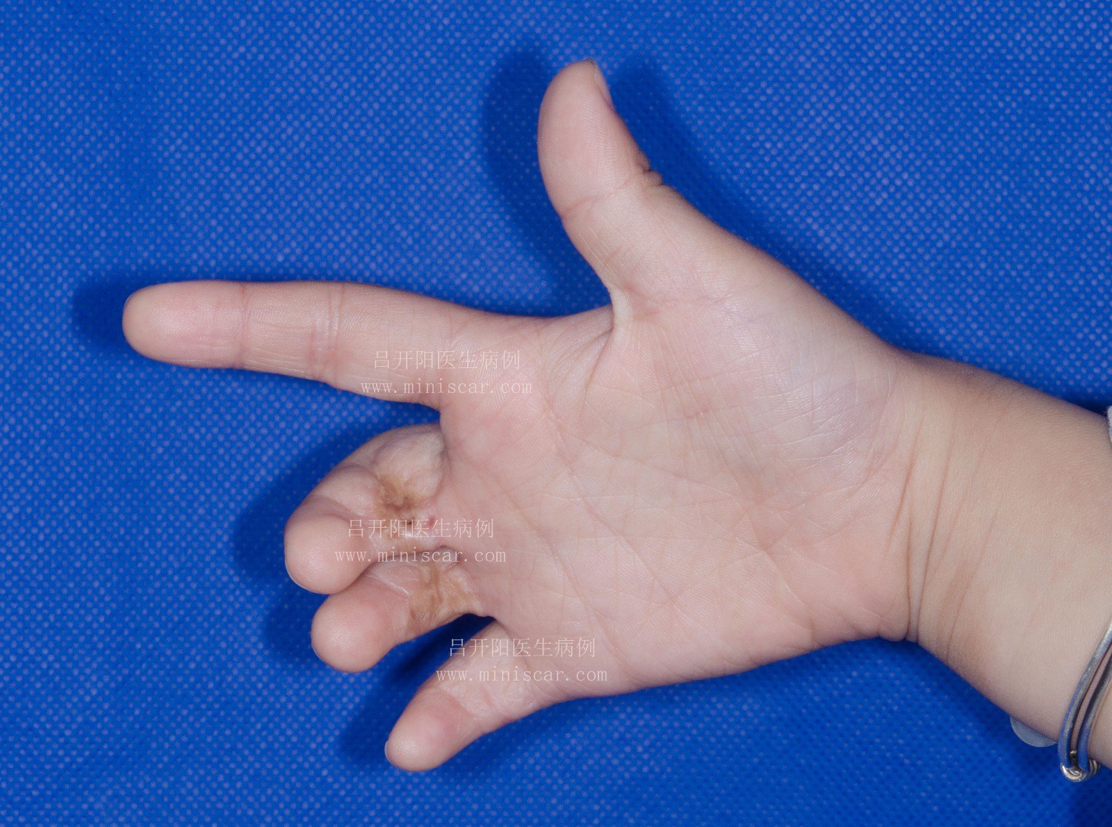 手臂燙傷脫皮了會(huì)留疤嗎__脫毛燙傷皮膚