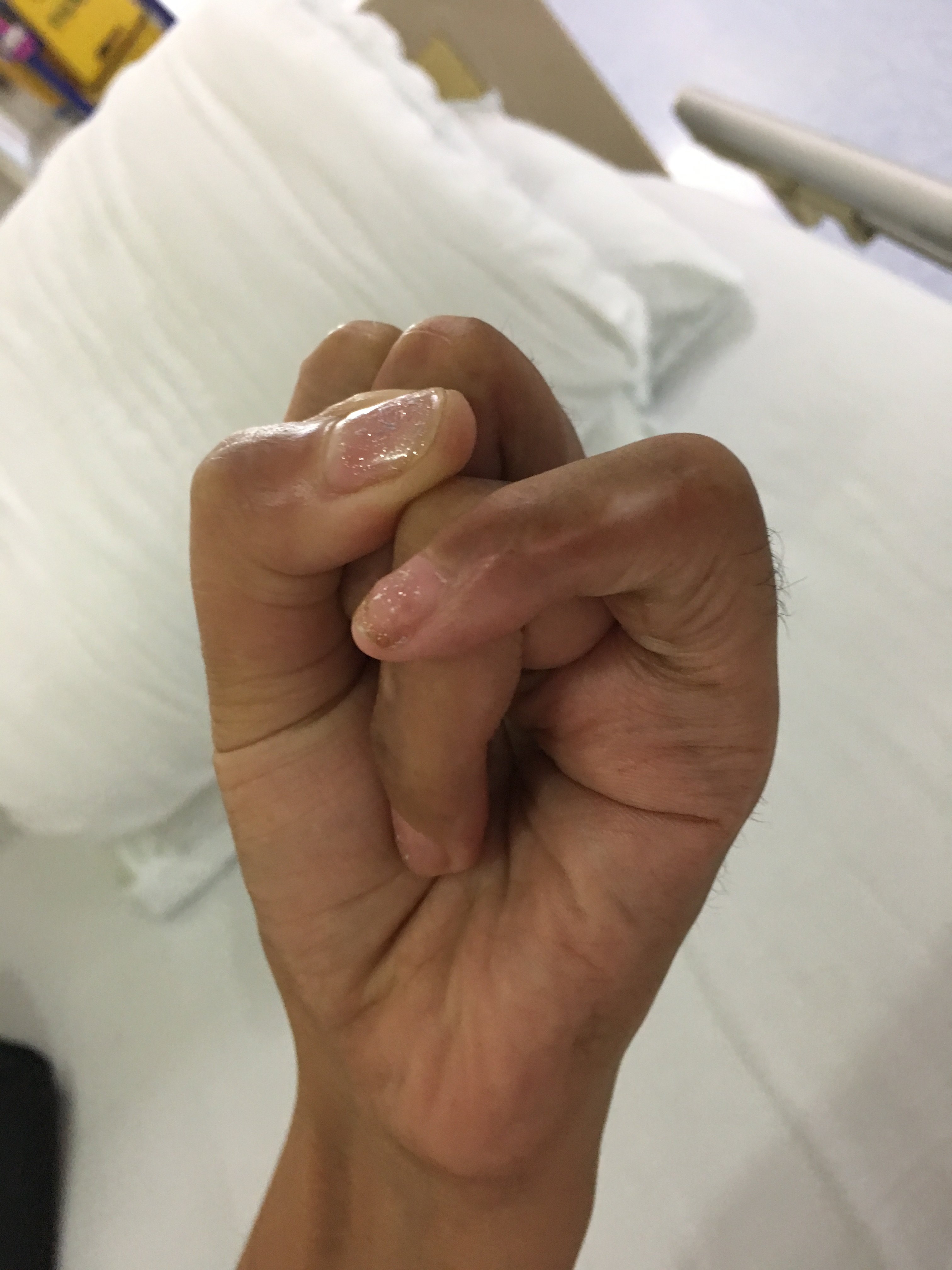 外伤导致的手指掌指关节挛缩的手术治疗效果 好大夫在线 外伤导致的手指掌指关节挛缩的手术治疗效果 好大夫在线