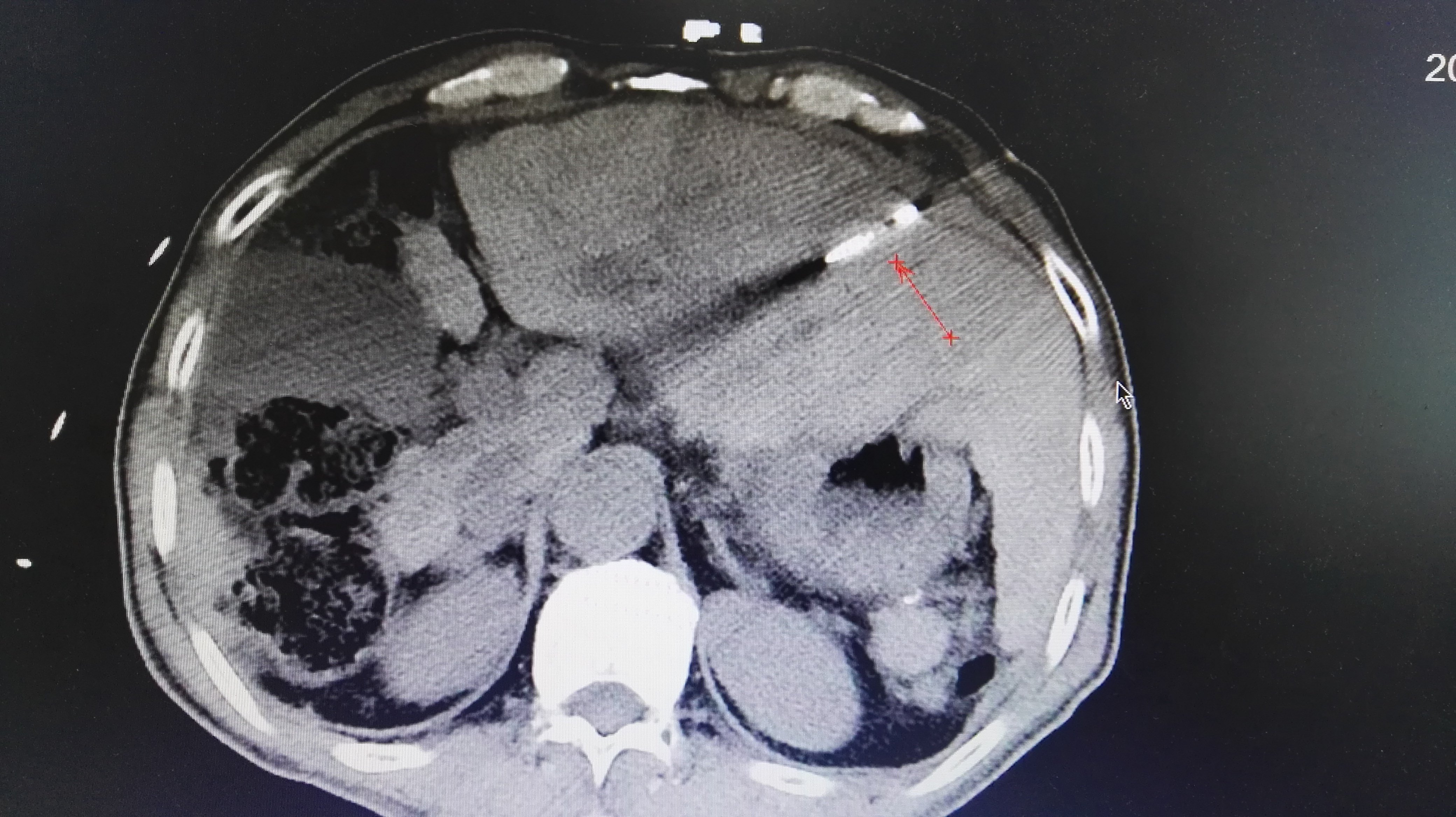 小肝癌微波消融术可达到根治性外科切除效果