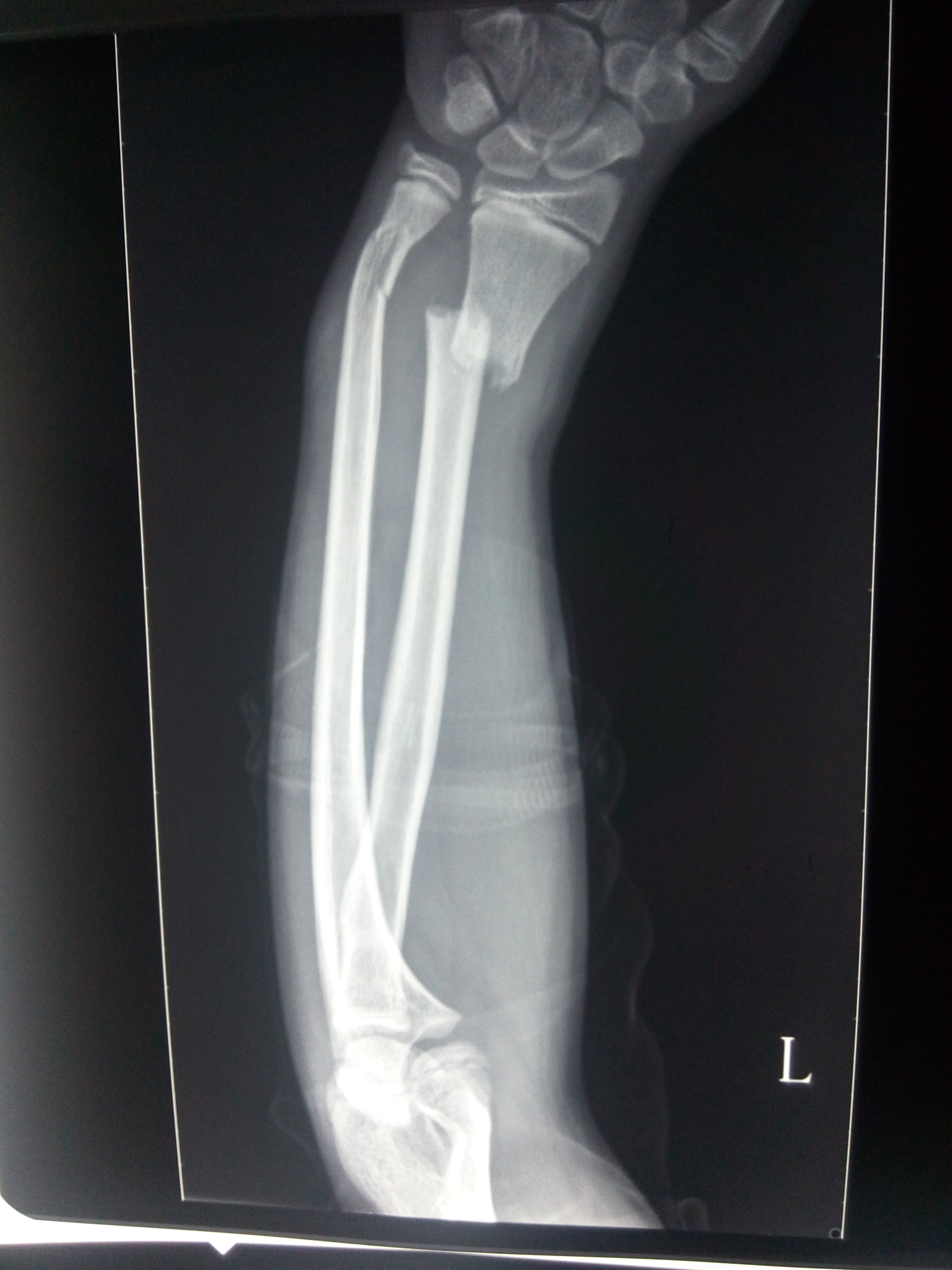 儿童尺桡骨远端骨折闭合复位外固定 
