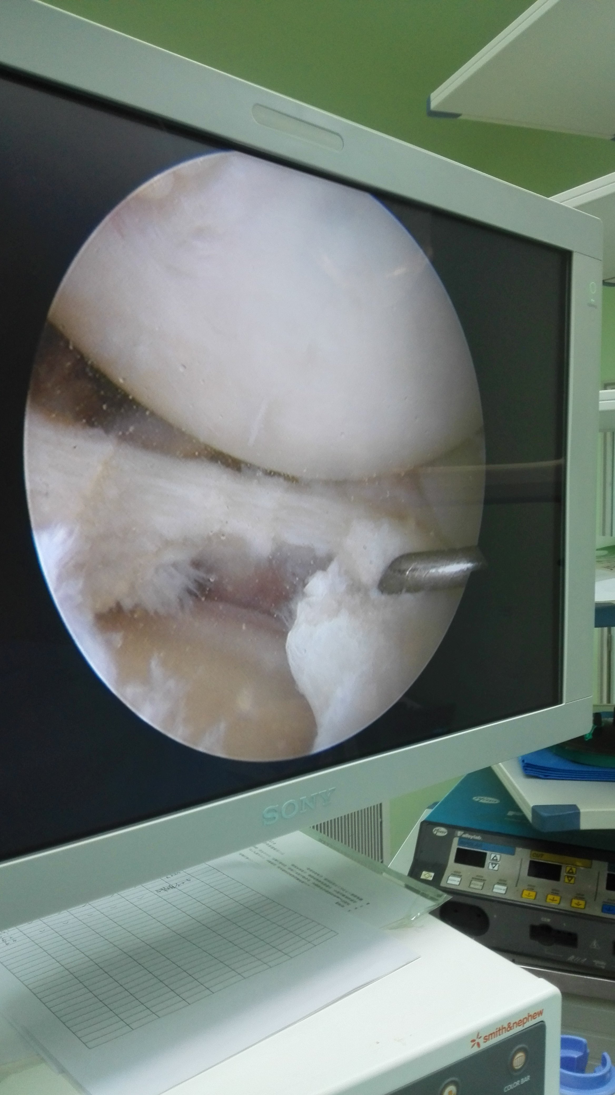 膝关节外侧盘状半月板