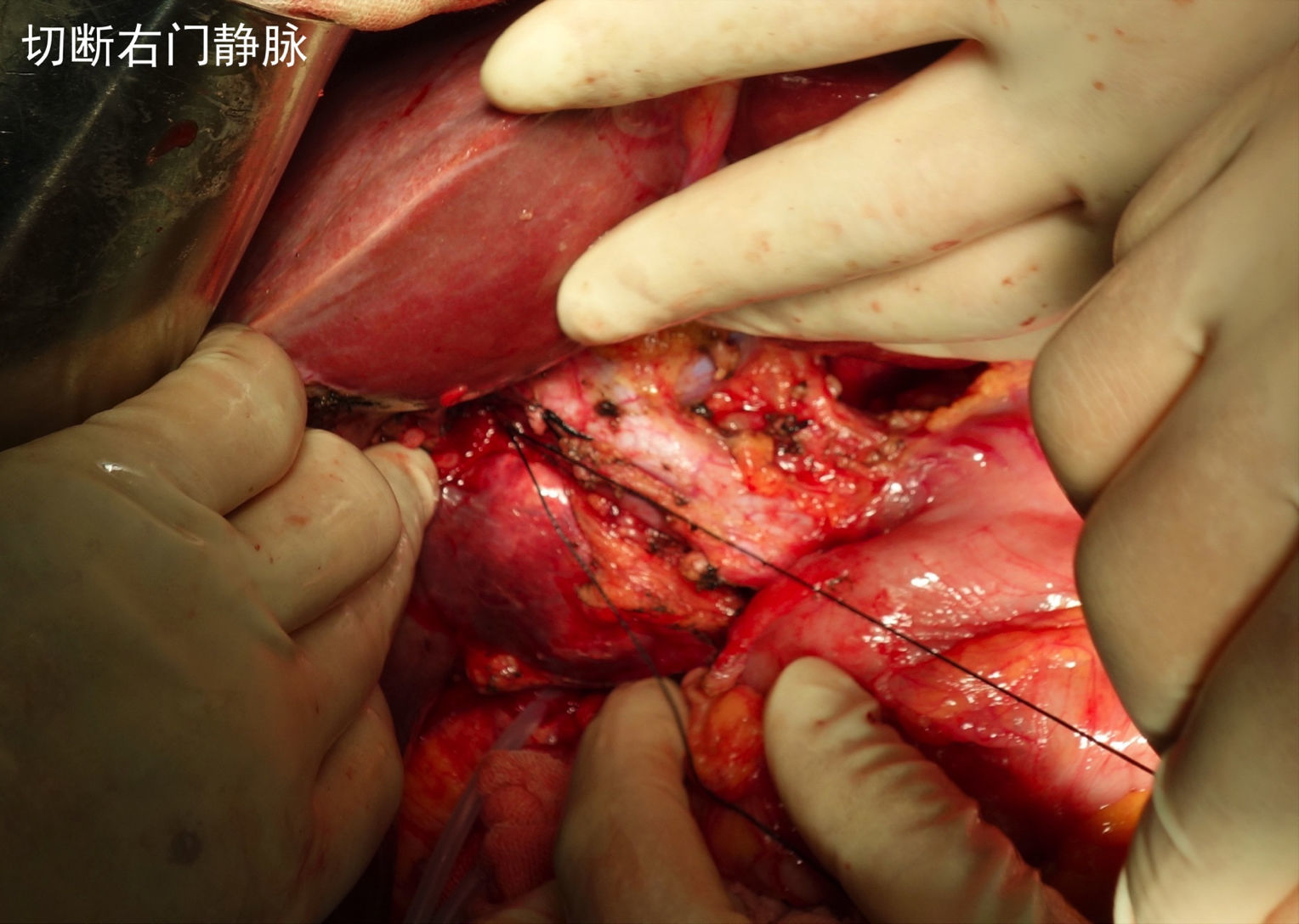 巨大尾状叶肝细胞肝癌切除术1例