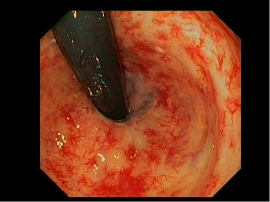 直肠炎的诊断与治疗