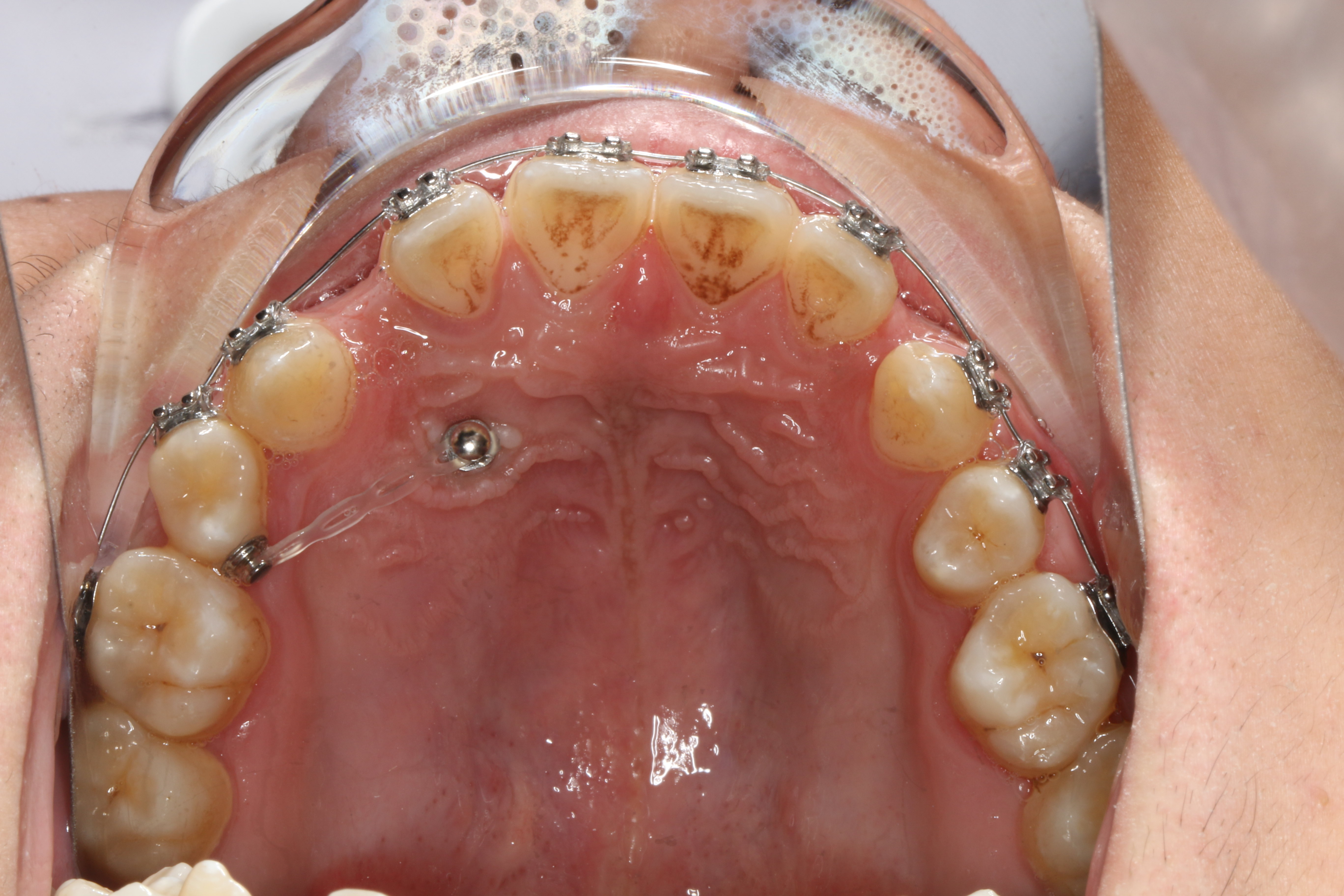 支抗钉～舒适-高效 - 好大夫在线