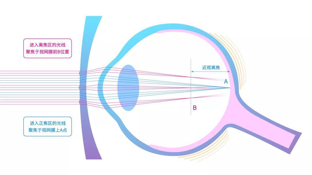 青少年近视防控新产品--新乐学多点近视离焦镜片