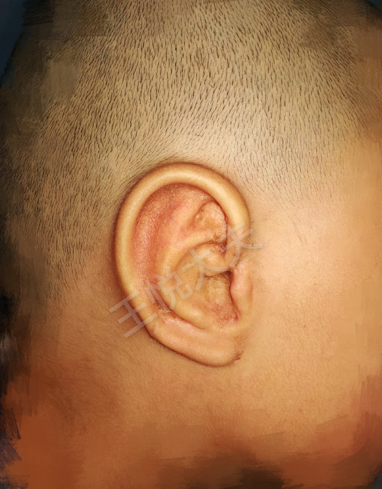 小耳再造手术典型病例照片(持续更新中)_耳再造_耳再造治疗介绍 - 好