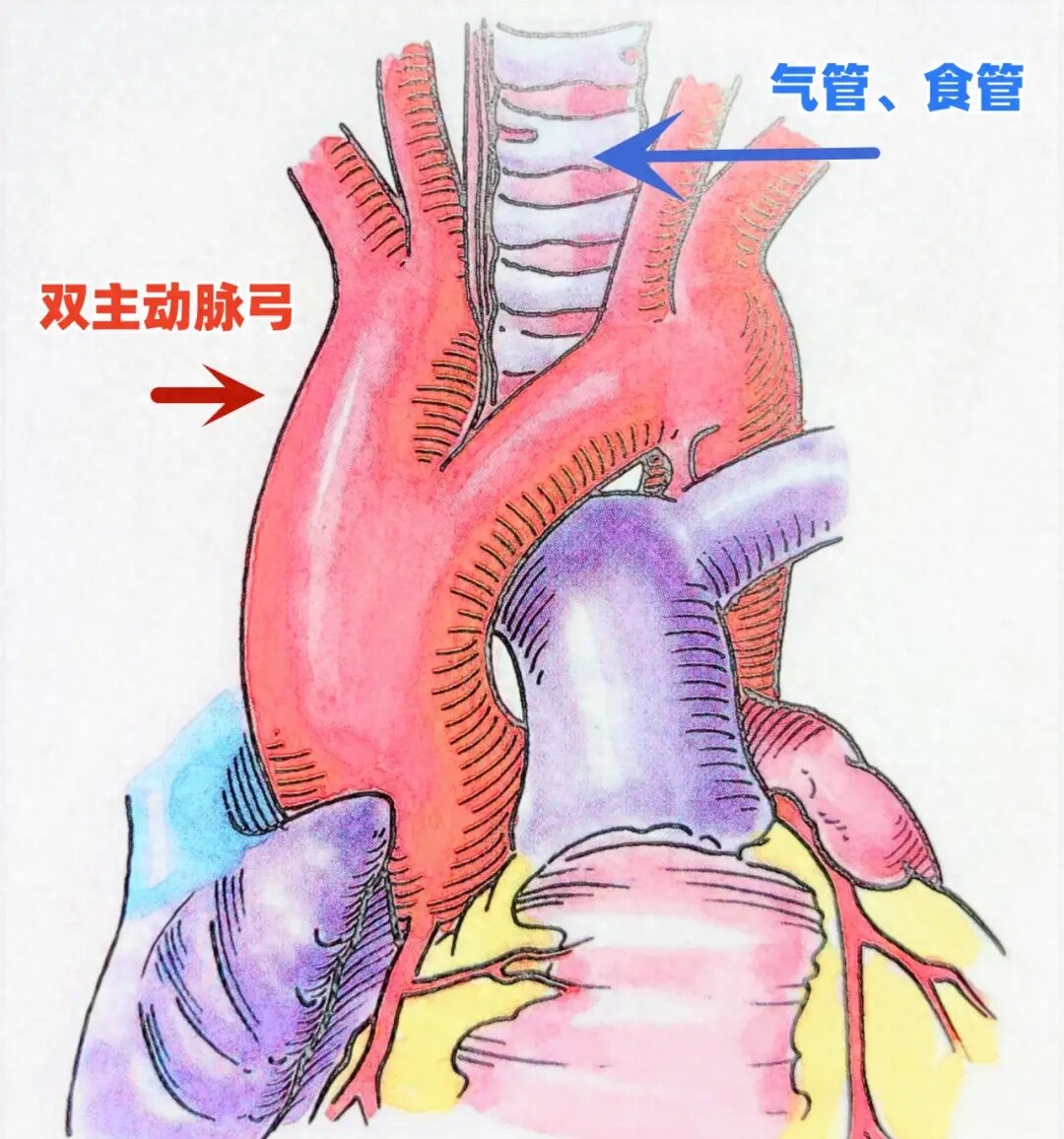 血管环之双主动脉弓