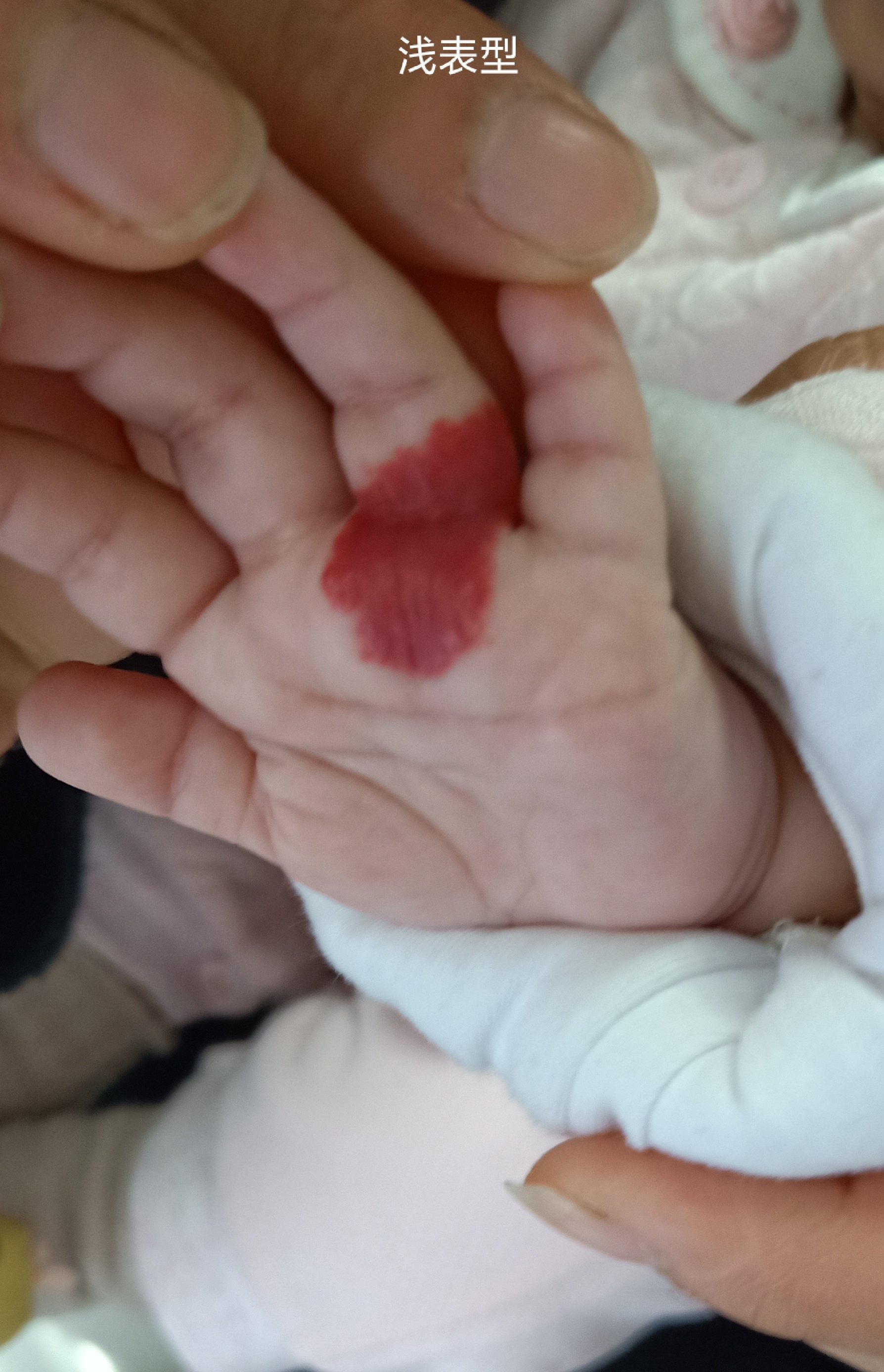 婴幼儿血管瘤治疗