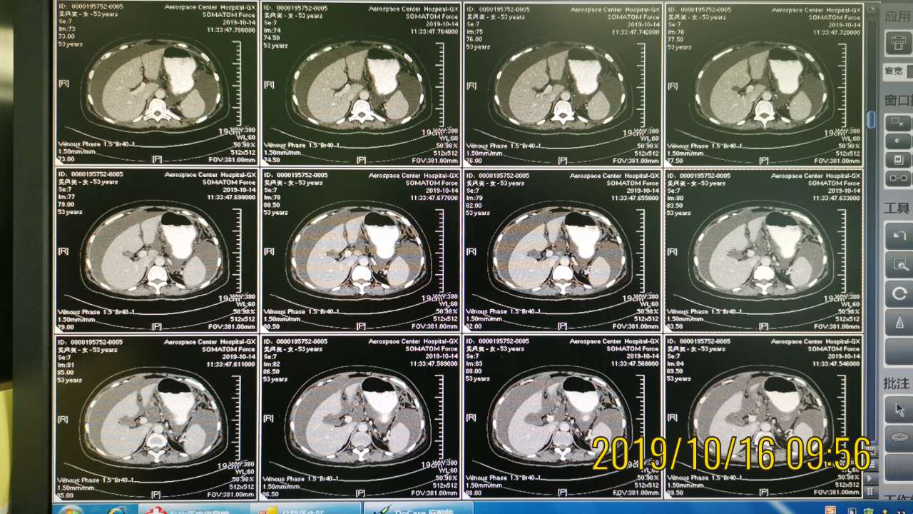 複查血ca125進一步升高,大於1000u/ml,查腹盆ct:腹腔積液,腹膜,大網膜