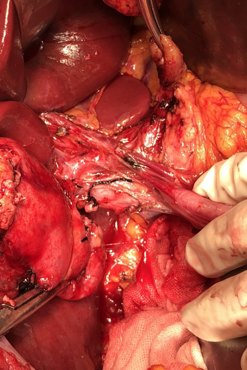 其二就是如果发现某些良性病变比如胆囊结石就不要一拖再拖,尽早手术