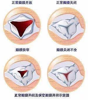 正常心脏瓣膜的开放和关闭有赖于瓣膜,瓣环以及腱索和乳头肌等结构,当