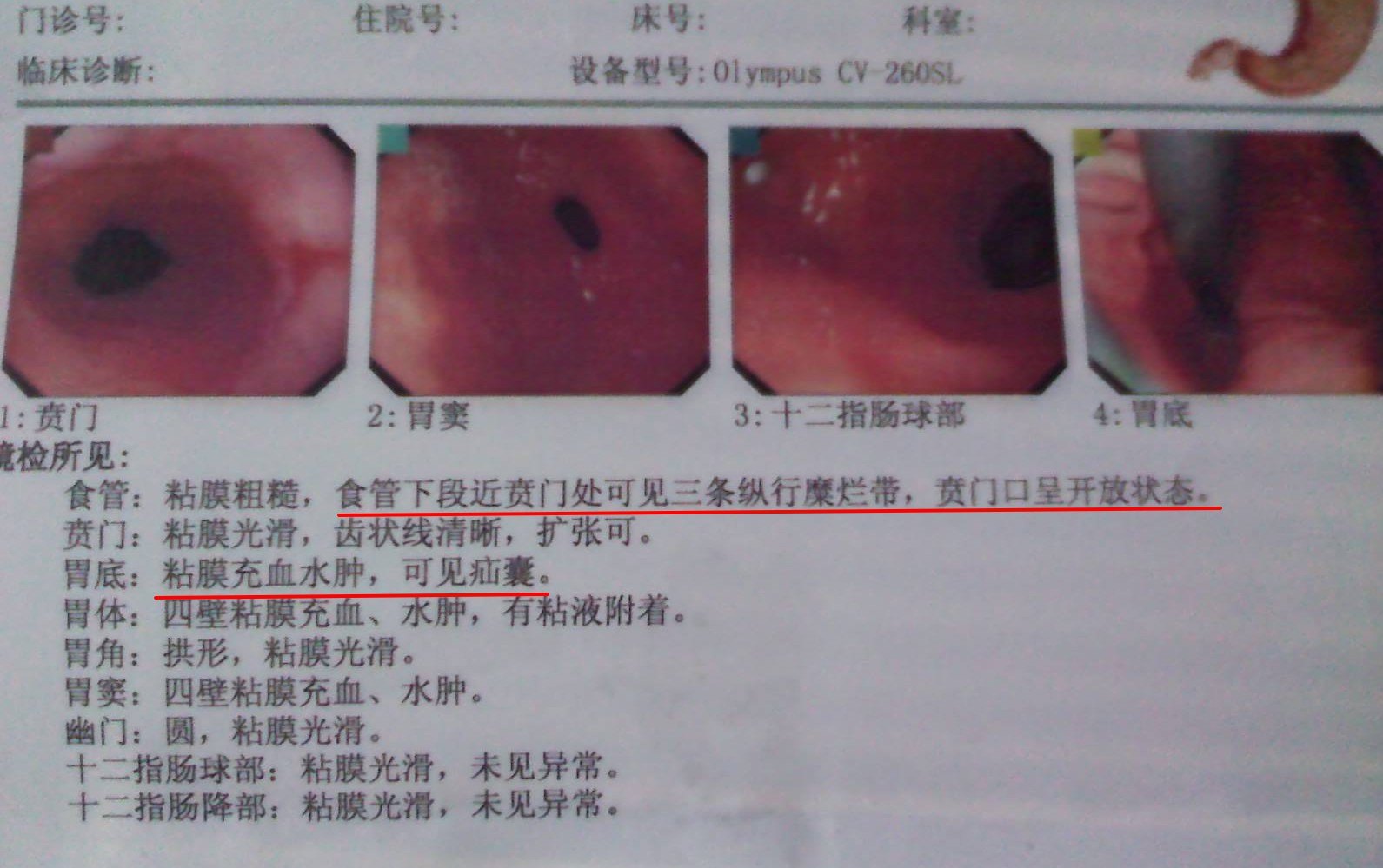 反流性食管炎胃镜图片