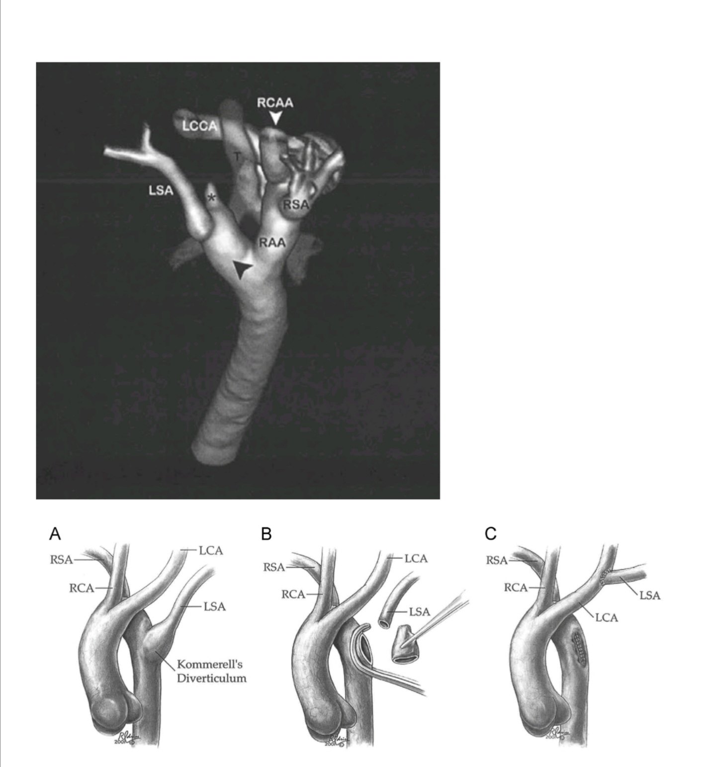 先天性血管环图片