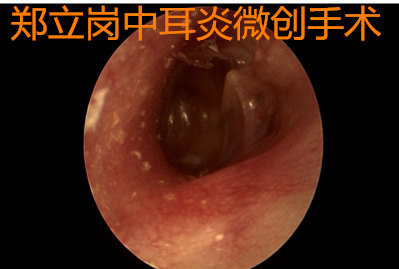 反覆中耳積液膽脂瘤形成耳內鏡微創及球囊擴張徹底解決