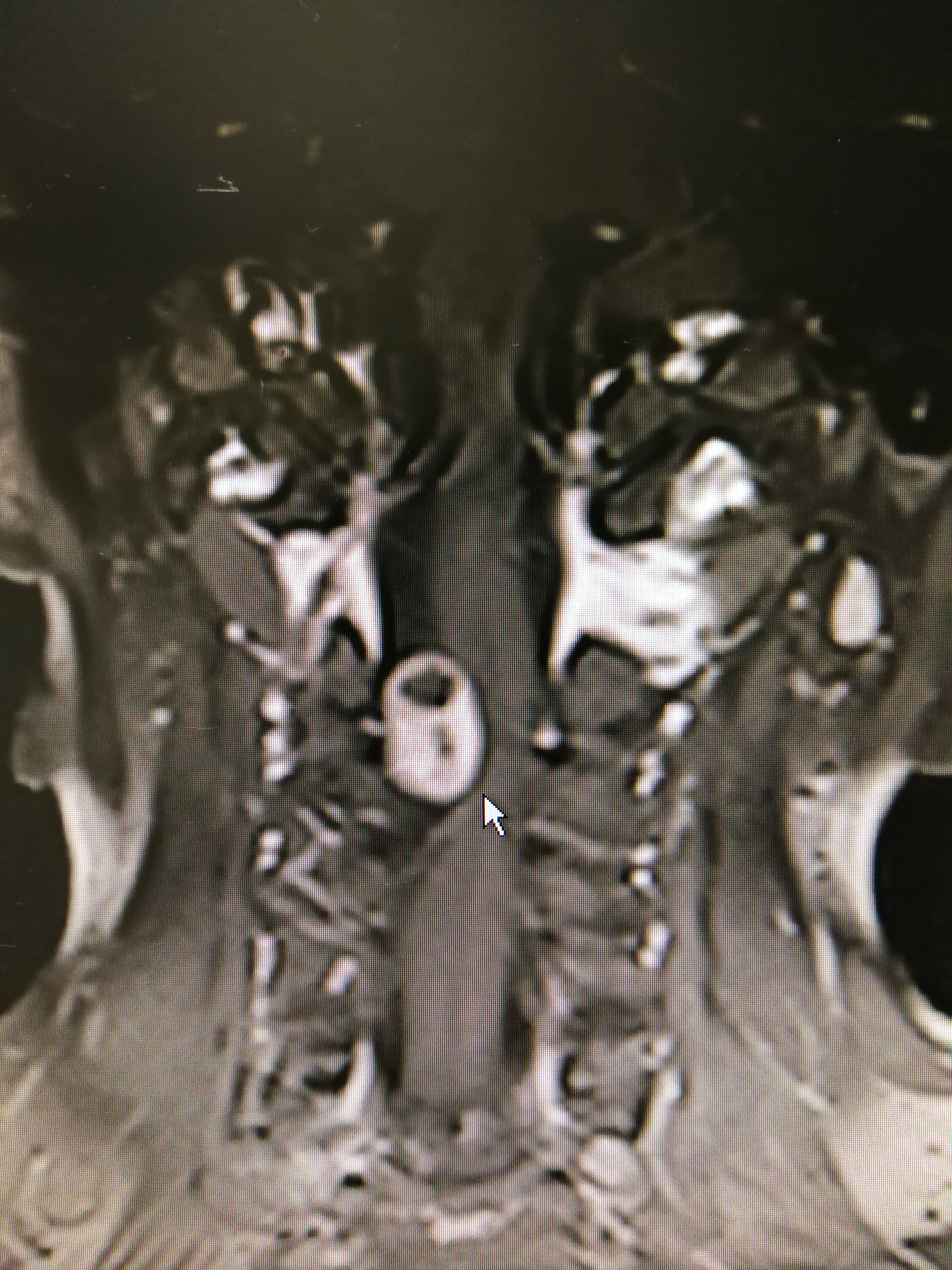 颈椎椎管内肿瘤切除术_椎管内肿瘤_椎管内肿瘤治疗方式 - 好大夫在线