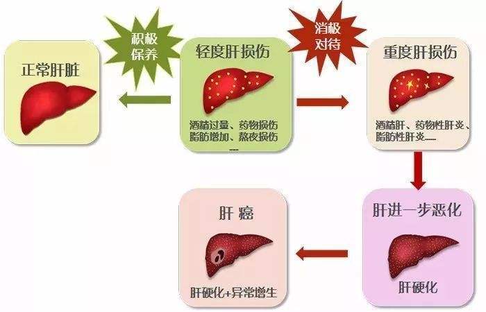 肝硬化距離肝癌只有一步之遙必須懸崖勒馬