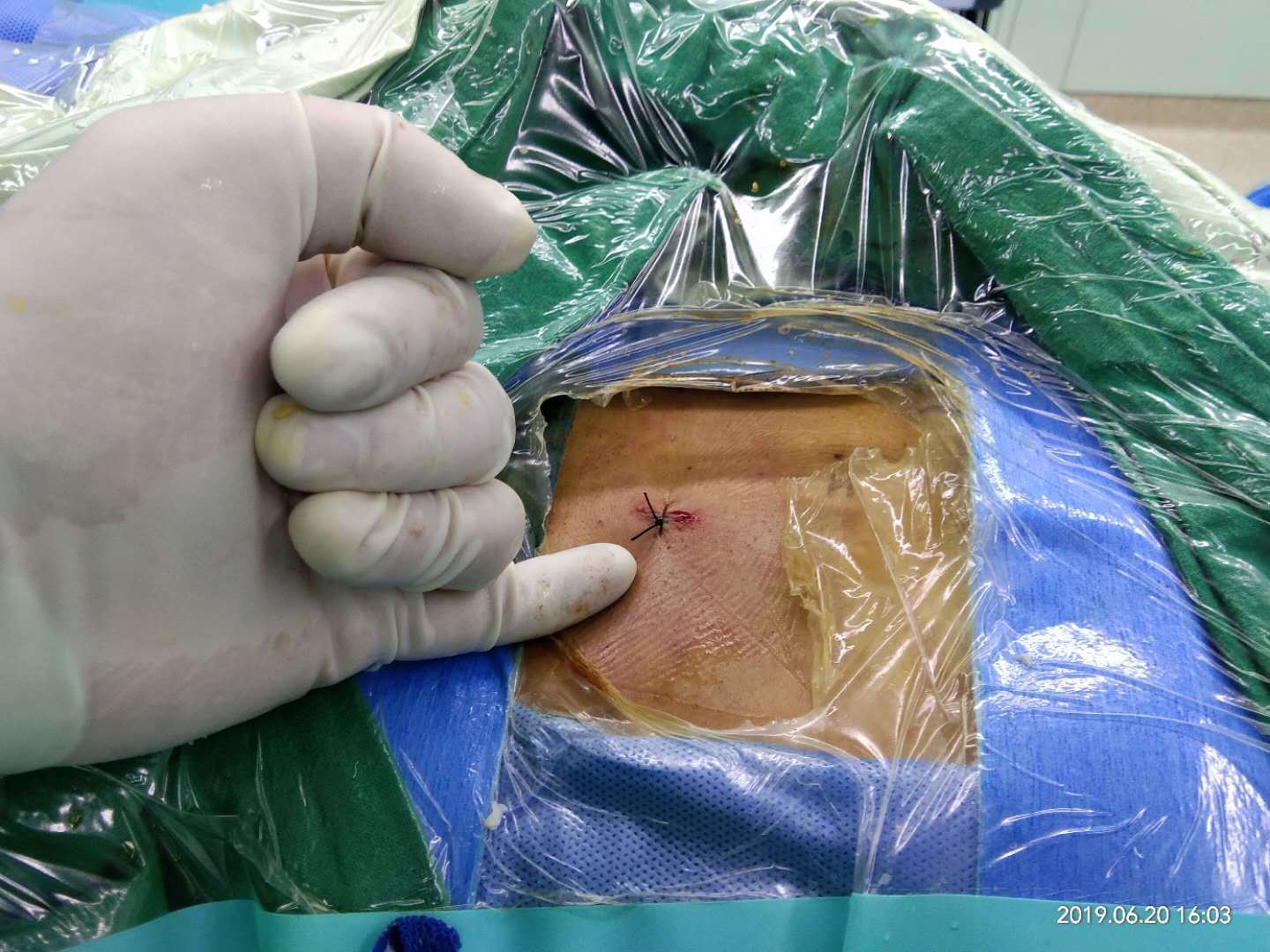 微创椎间孔镜治疗钙化型腰椎间盘突出症病例 - 好大夫在线