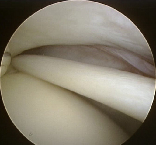 肩关节前侧疼痛原因之什么是肱二头肌长头腱肌腱炎怎么诊断怎么保守