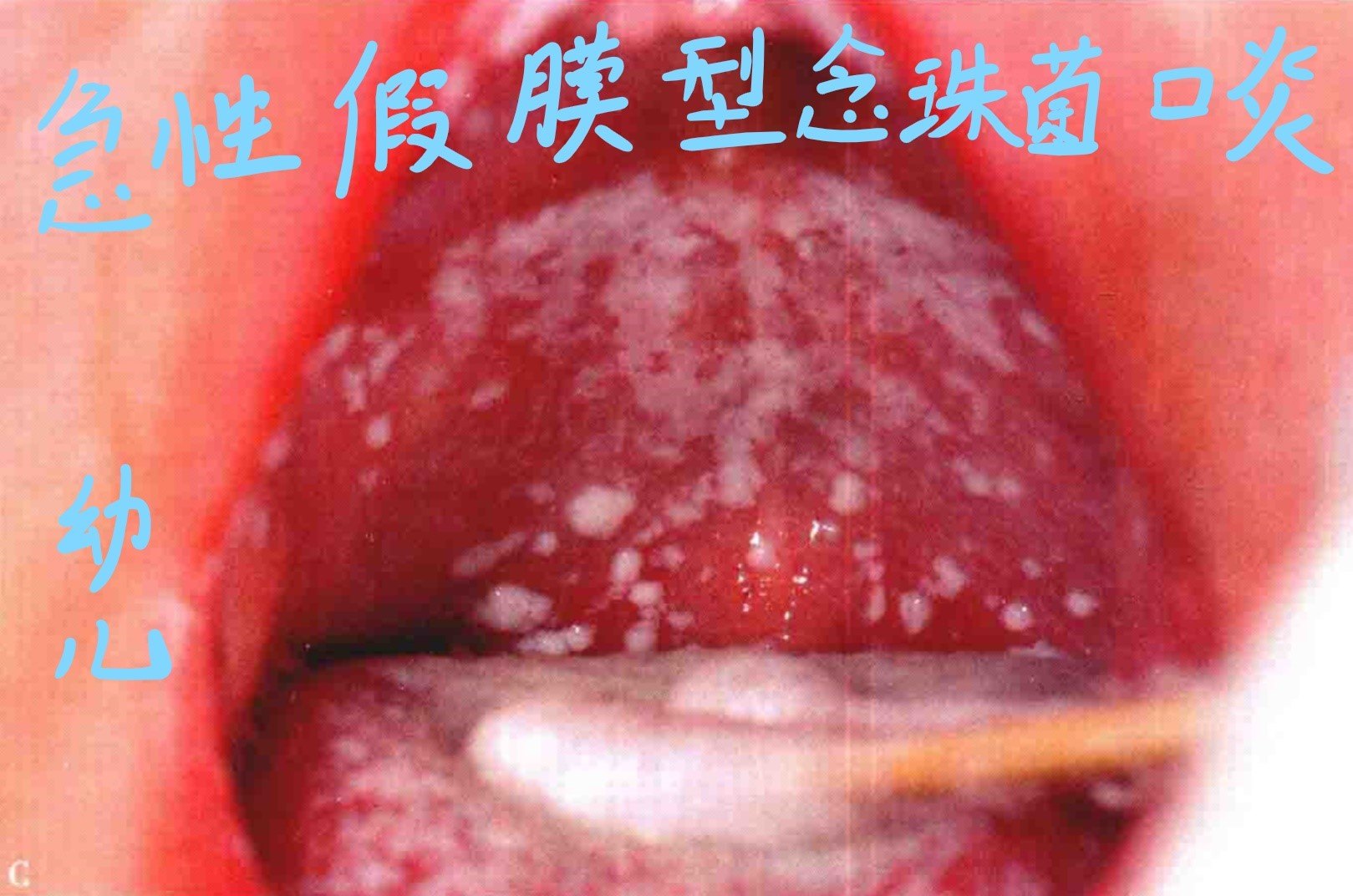 霉菌性口腔炎图片