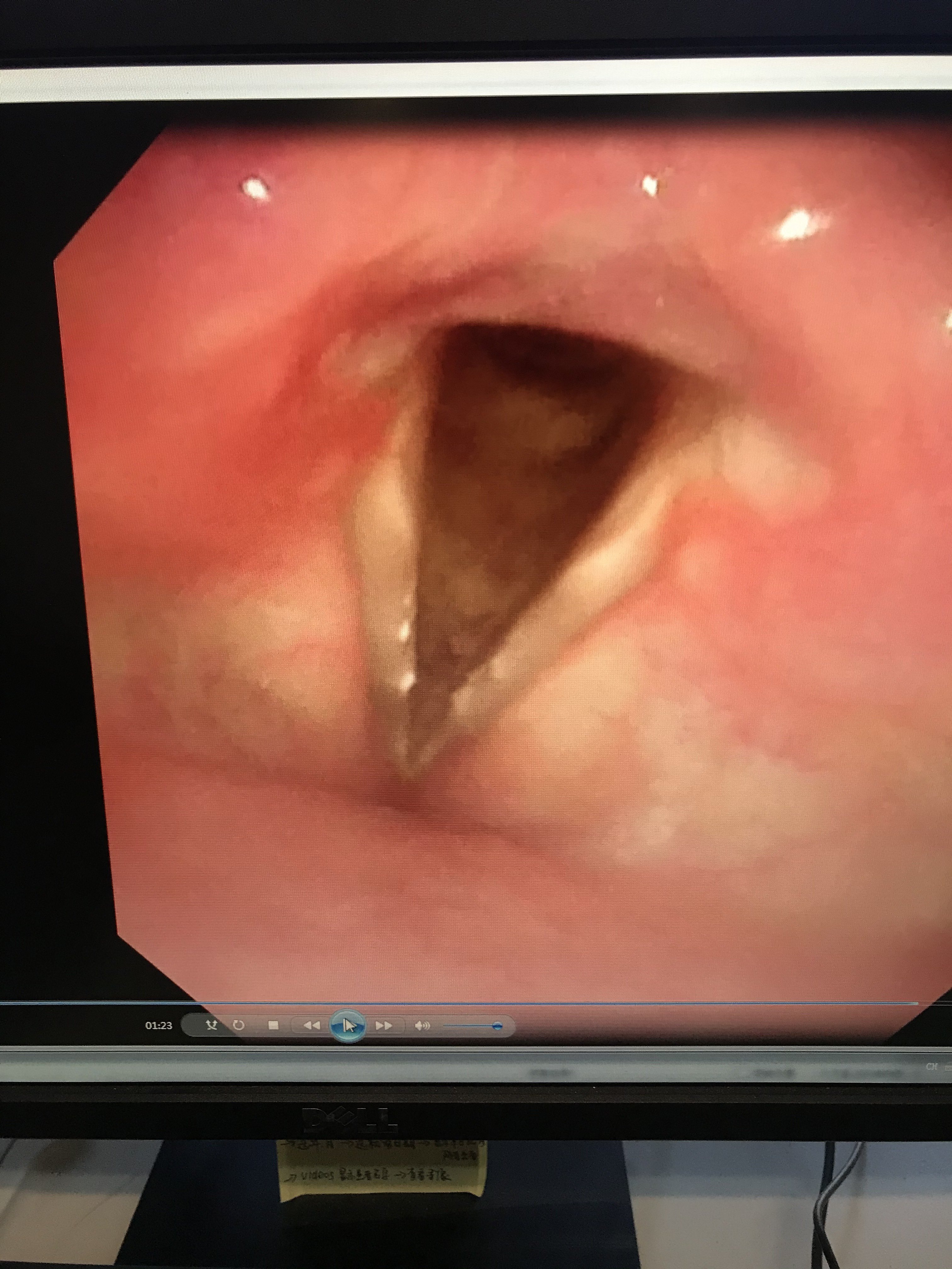 慢性喉炎的喉镜图像及治疗方法
