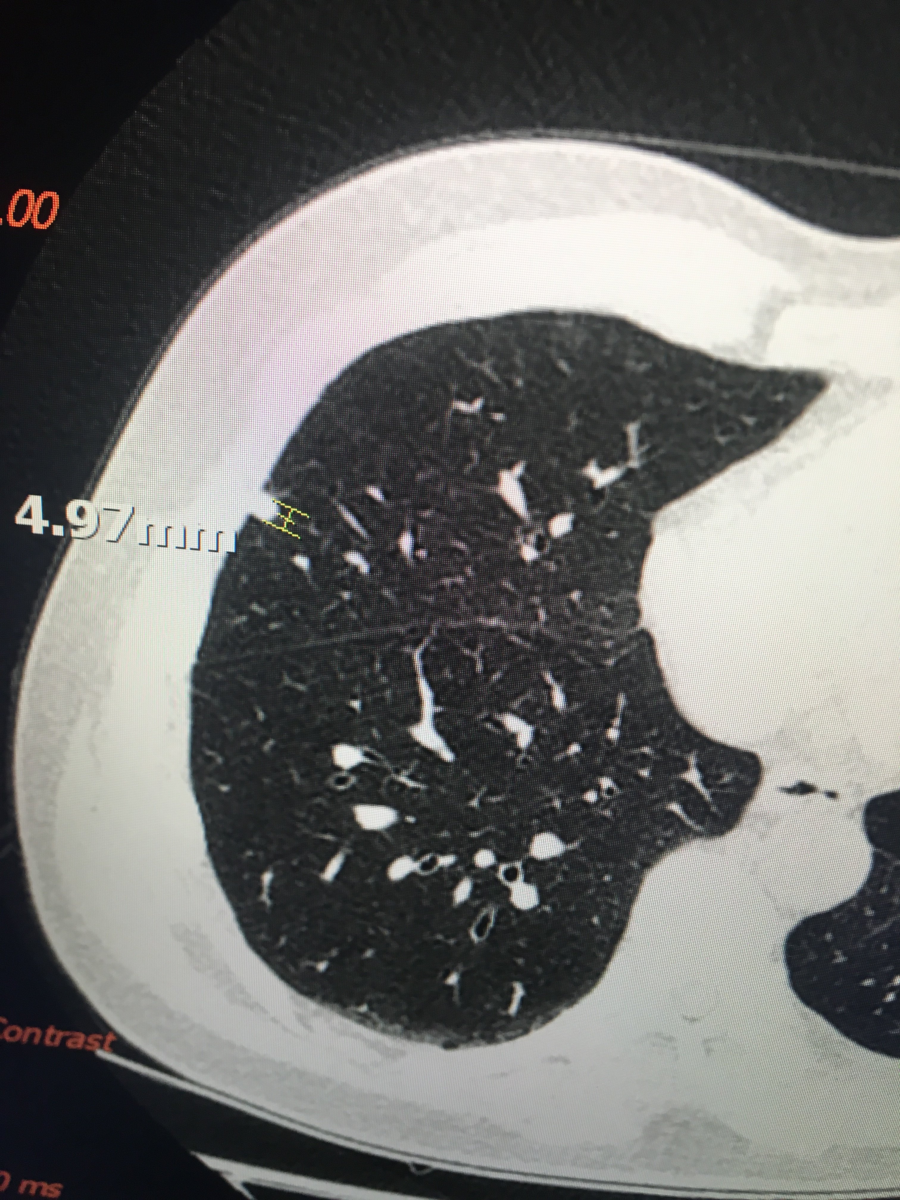 【案例】肺磨玻璃结节术后,实性结节长大了 - 好大夫在线