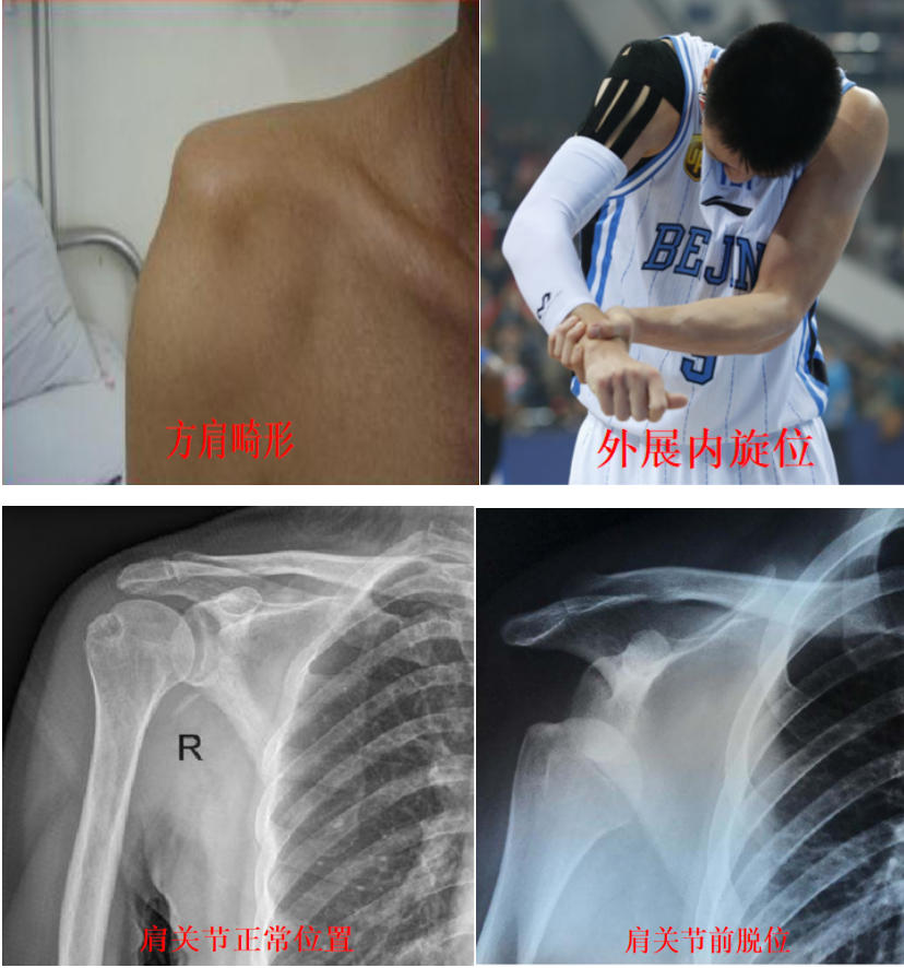 首次肩关节前脱位的治疗策略