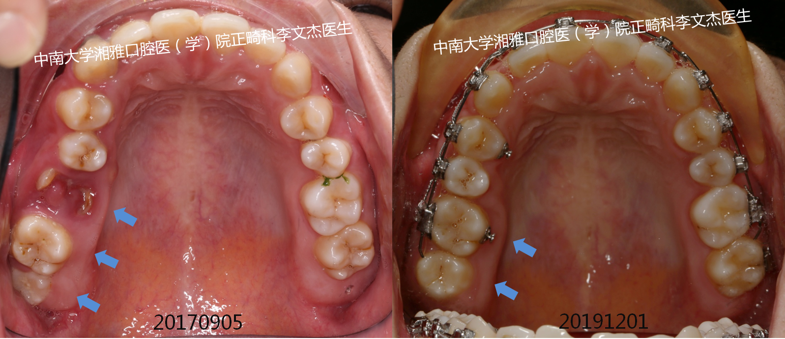 在我們詳盡診斷分析和不懈努力下,將右上智齒(18)和第二磨牙(17)一起