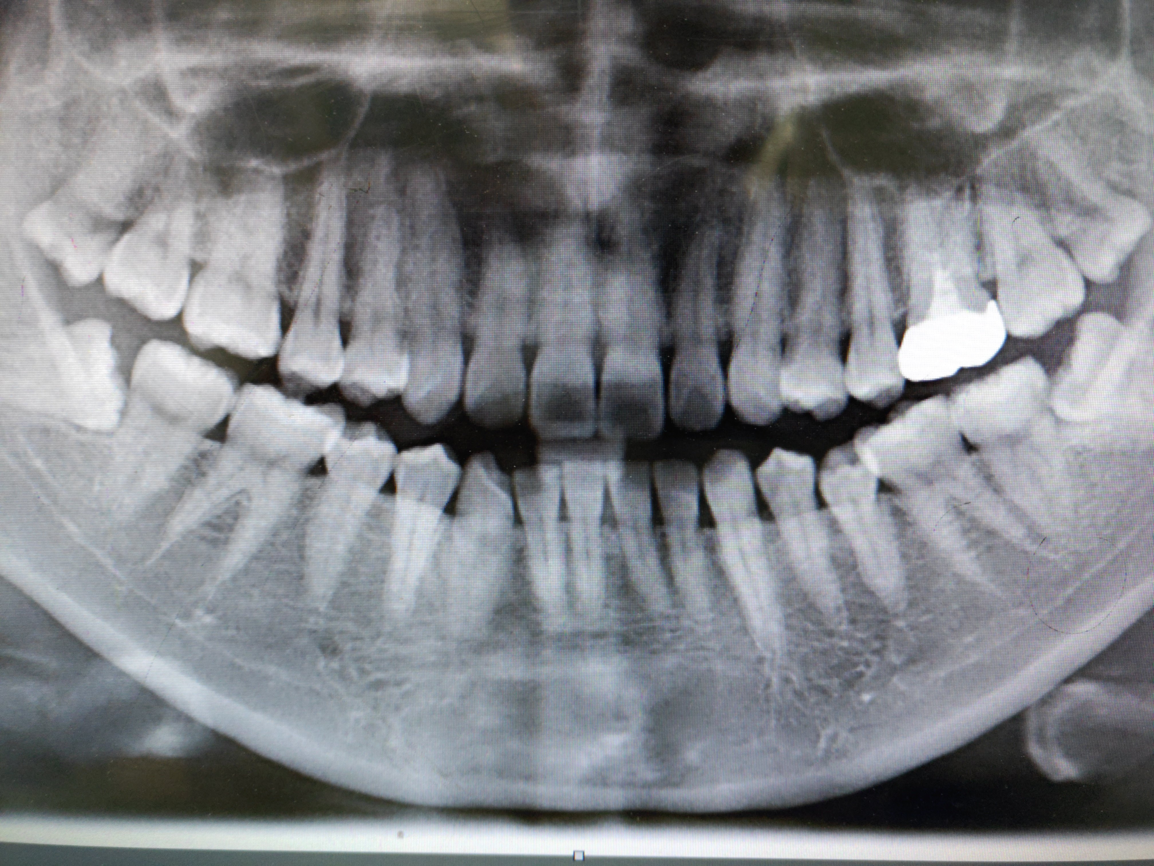 智齿用不用拔 看懂就懂啦 阻生齿 阻生齿