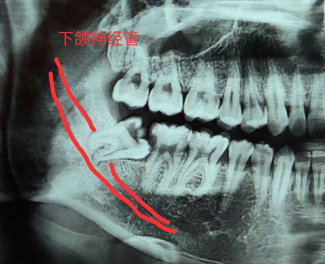 下牙槽神经图片图片