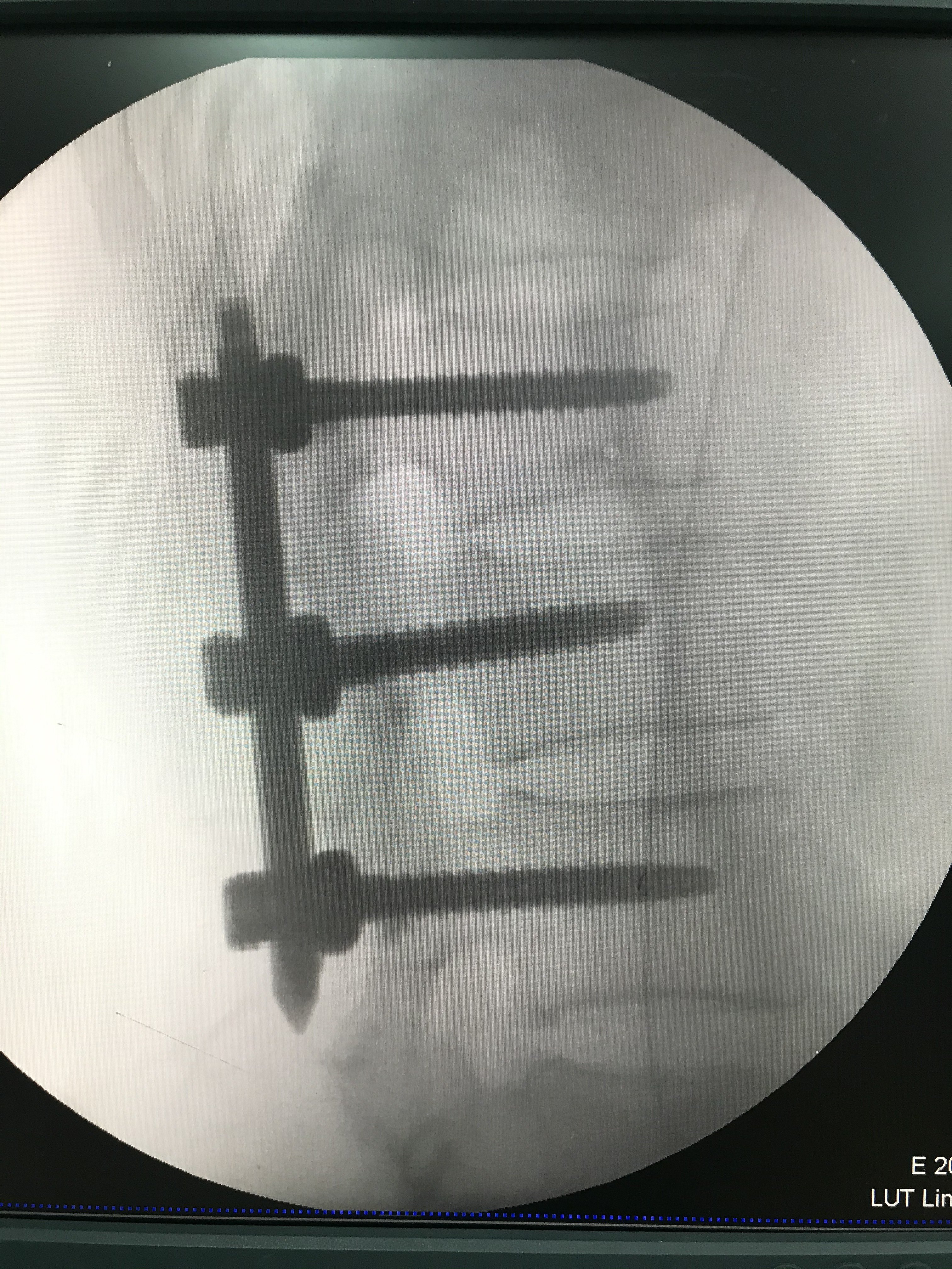 机器人导航微创经皮置钉降低脊柱手术风险_脊柱骨折_脊柱骨折治疗方式
