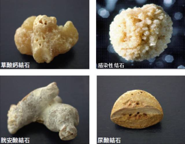 碳酸钙/碳酸磷灰石;非含钙结石如胱氨酸结石,黄嘌呤结石,尿酸/盐结石