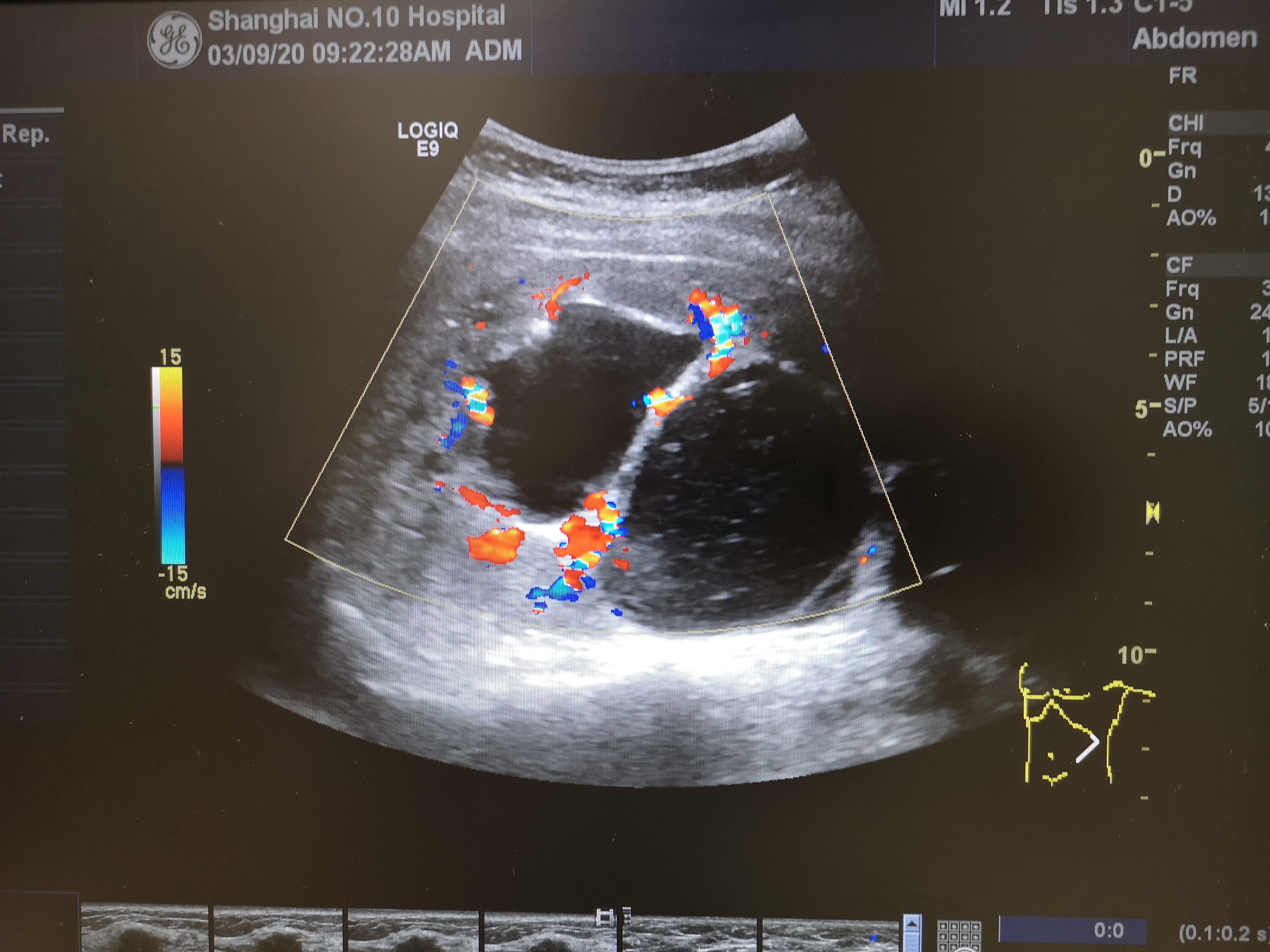 不同的超声医生诊断结果为什么不一样?多囊肾合并肾积水 - 好大夫在线