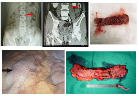 (2)结直肠癌切除一期吻合±预防性造口术;(3)hartmann术后二期吻合术