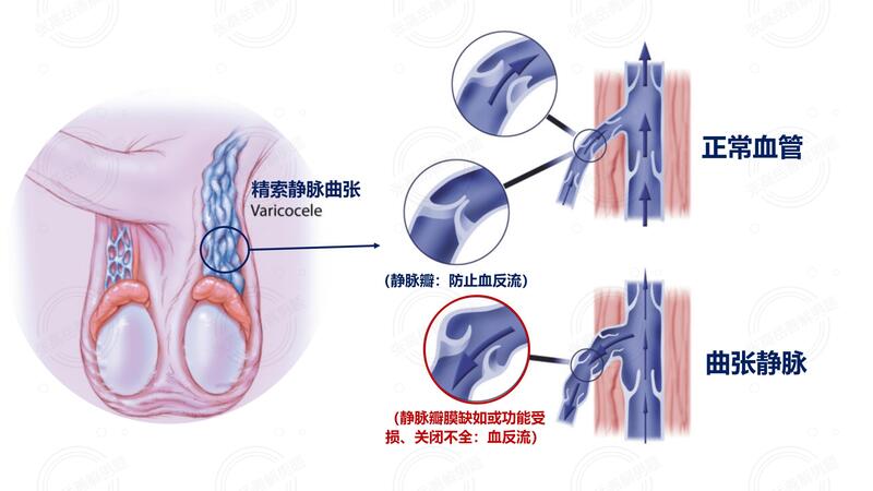 图：精索静脉曲张的血管表现.jpg