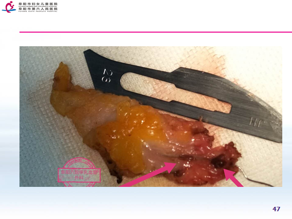乳腺导管内窥镜图片