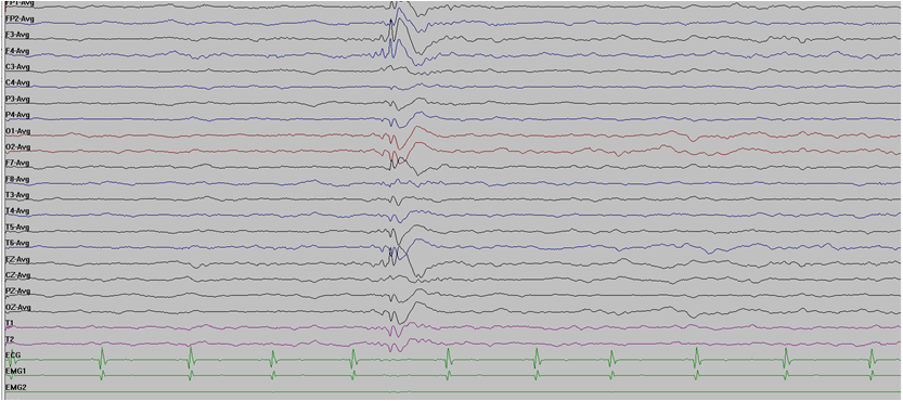 脑电图有异常放电 一定是癫痫吗?_脑电图_脑电图介绍 - 好大夫在线