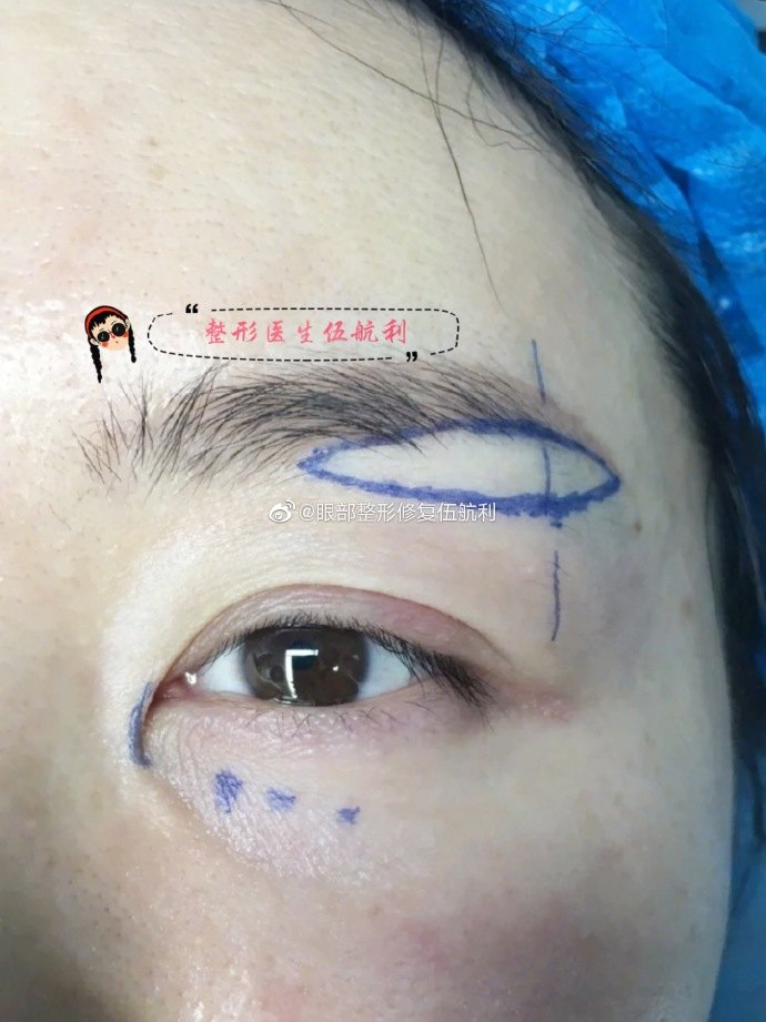通过去除多余的眉下皮肤,向上提升术相对于注射肉毒素来说提升眉部的